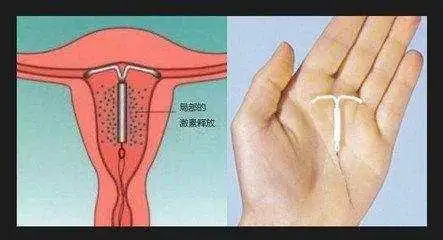 生完孩子三月后就上环了,15年后取出的环让医生吓懵