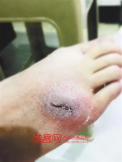 女子乘轨交被高跟鞋踩伤 索赔时对方却关机