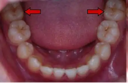 做好龋齿的防治 让孩子终身受益 | 大丰123网