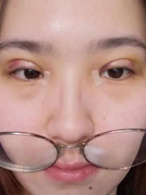 项目是埋线加吸脂开眼角,三项手术. 我觉得我的效果还是可以的!