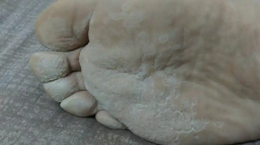 我脚经常出汗!冬天有时也会出汗!今天走了好多路!