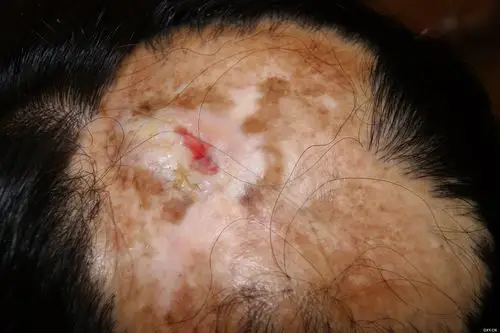 【讨论】局麻下扩张器修复头顶大面积疤痕秃发心得 [病例帖]