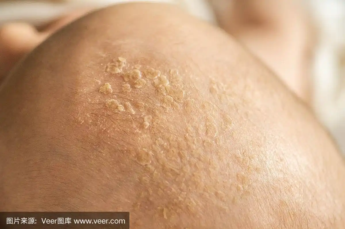 婴儿皮在头上.婴儿头部脂溢性皮炎,特写,脂溢性皮炎,炎症