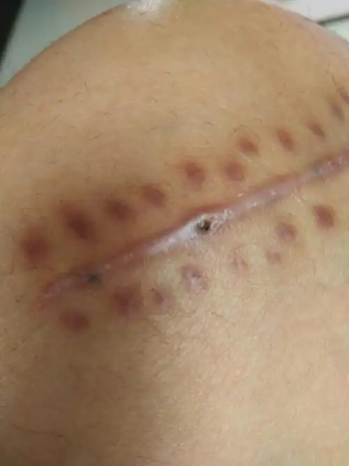 伤口排出线头拽不动怎么办