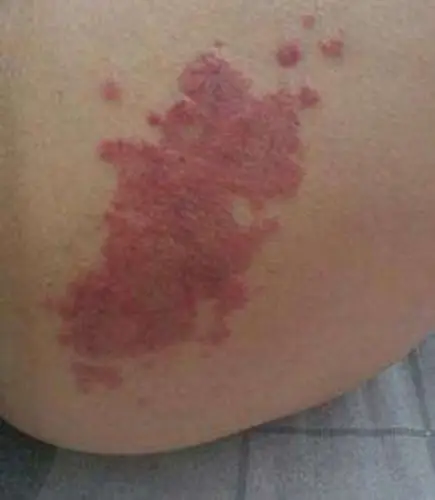 女性股藓症状表现的图片_有来医生