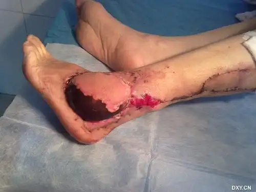 腓肠神经营养皮瓣坏死一例讨论