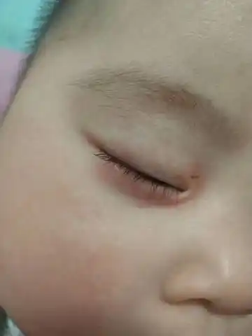 宝宝六个月 下眼睑总红 痒 孩子总揉 谁知道是怎么回事?