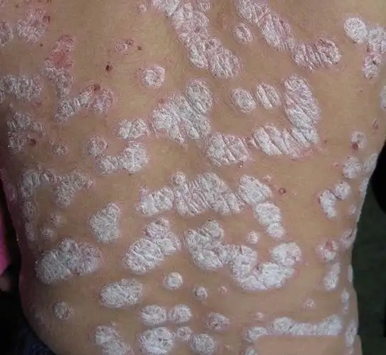 小孩颈部癣的症状图片_银屑病求医网