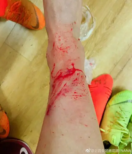 慎入!女足杨莉娜赛后晒右腿受伤照 鲜血淋漓惹人疼