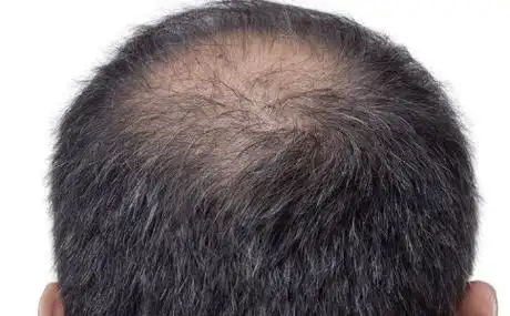 男性脱发是什么原因 该如何治疗_99健康网