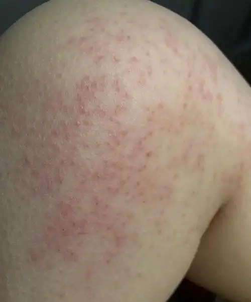 救命啊!腿上密密麻麻的疹子,这是怎么了