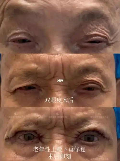 老年性上睑下垂修复