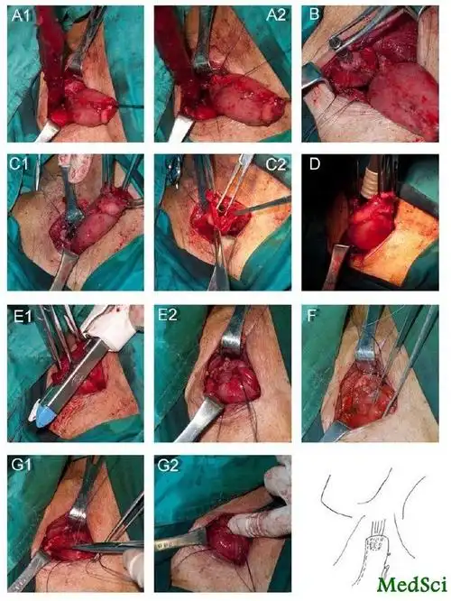 aso:河南省人民医院副主任医师务森发现通过环型吻合