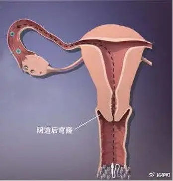 676767什么是阴道后穹窿?