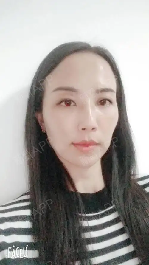 今天术后第五天了,已经没有多大感觉了,脸紧绷了很多,提升效果