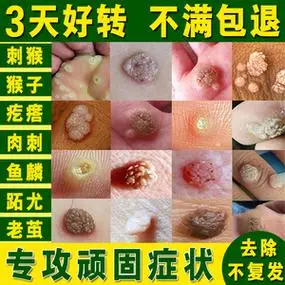 祛刺猴肉刺去除膏去猴子肉粒疙瘩的药正品手部鱼鳞痣痦子专用神器