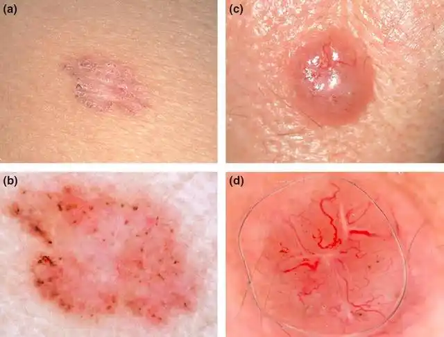 手把手教程:皮肤镜评估基底细胞癌