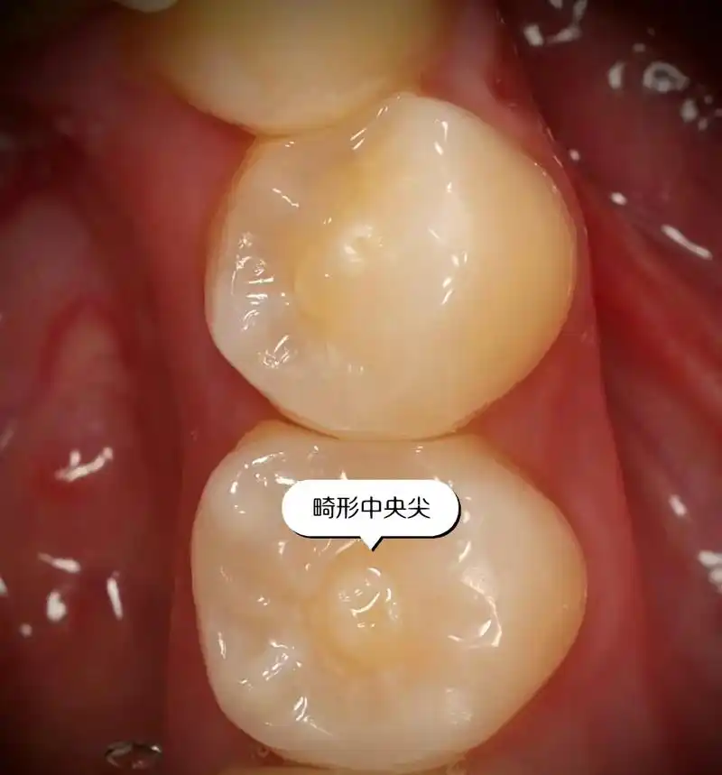 牙齿中间的小尖尖.