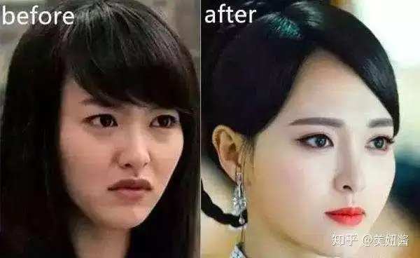 今天来谈一些误区颧骨高下颌骨宽大难道只能颧骨内推或磨骨吗