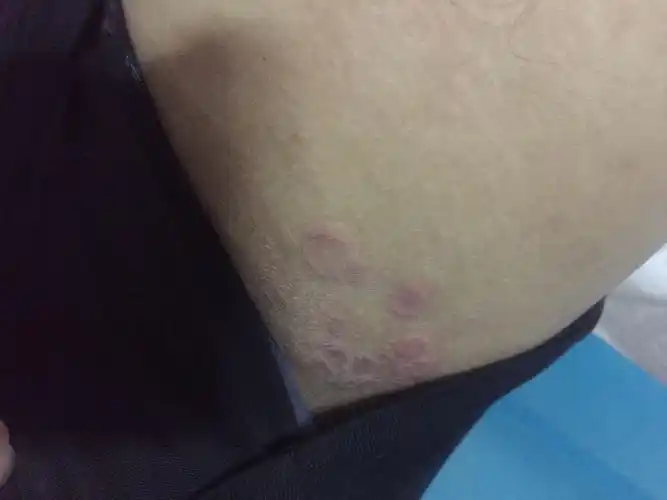 大腿内侧这是什么,会痛