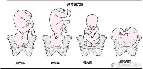 胎位loa是什么意思呢?