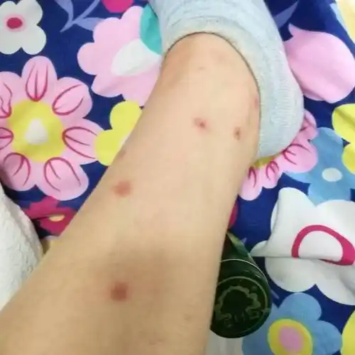 跳蚤为什么有的人咬有的人不咬 它们为什么喜欢咬脚踝和腰-走红网