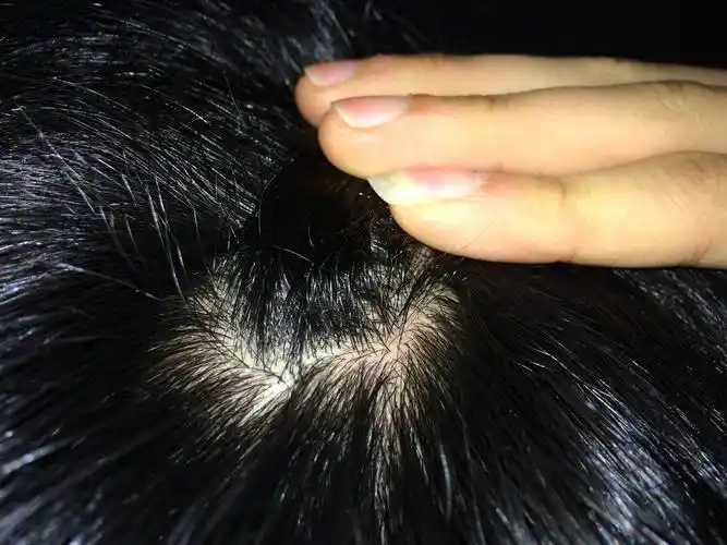 是热症要怎么治疗? 麻烦各位专家请指点一下我该怎么办.