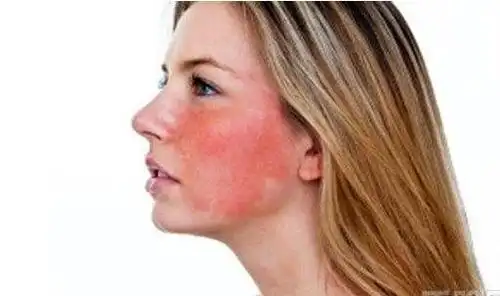 改善红脸蛋!教你淡化红血丝的6个窍门