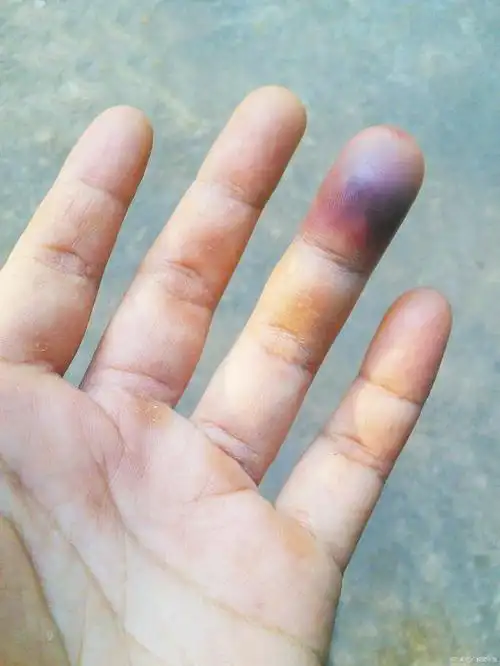 手指发紫是一种常见的现象,通常与循环系统或呼吸系统的疾病有关.