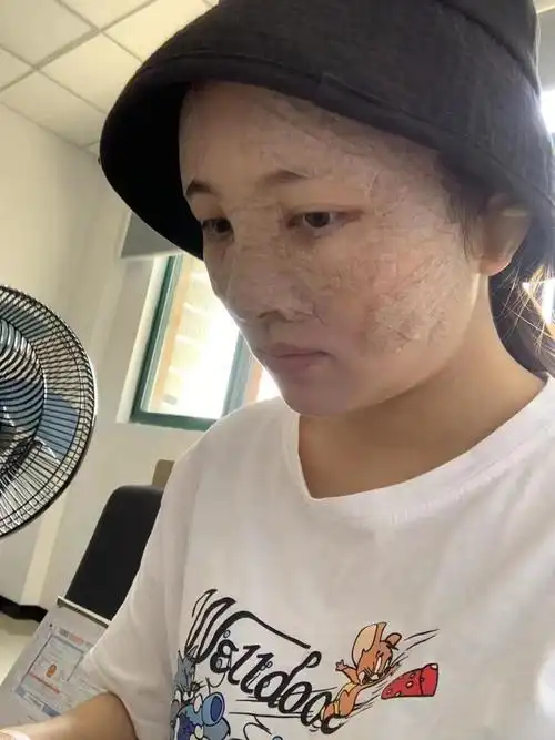 自体脂肪填充全脸第三天;刚做完那会肿胀是真的严重,现在已经好了很多