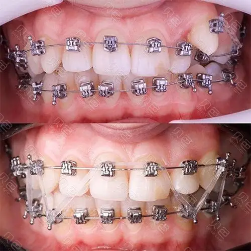 你们谁知道有虎牙的怎么矫正,不能拔!拔了会让嘴巴塌陷