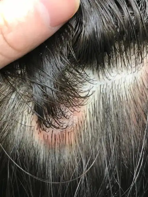 头皮问题轻松解决