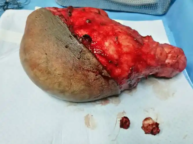 毛囊闭锁三联症之巨大阴囊病损切除 - 好大夫在线