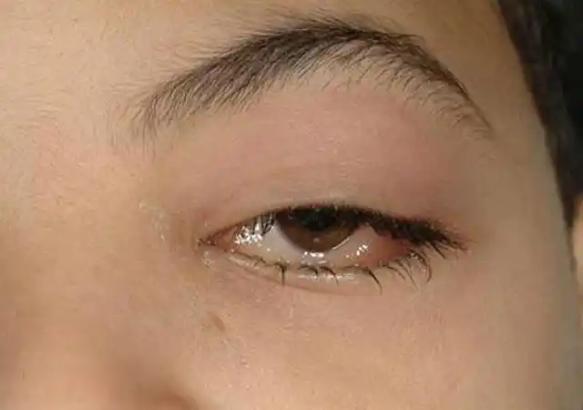 肾病眼皮肿图片肾不好眼睛浮肿的图片