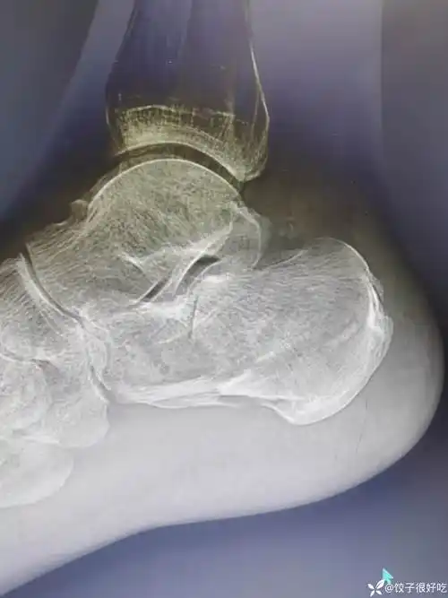 跟骨骨折微创是趋势