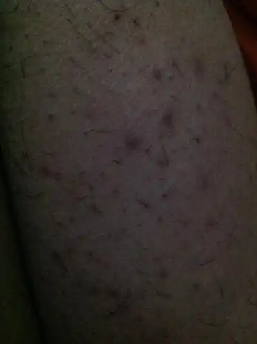 腿上毛孔发炎 已经有段时间了 好不去怎么办