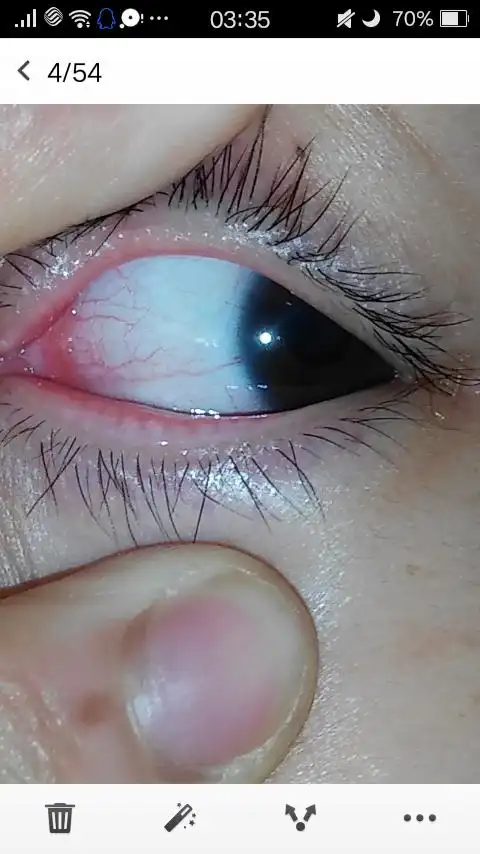 怎样去掉眼睛里的红血丝?