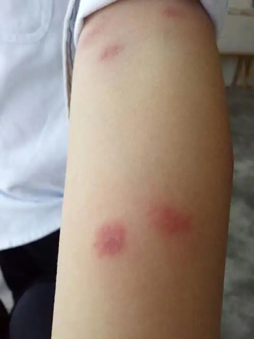 早上起来看到身上有很多红疙瘩,给涂了无极膏,盐水洗了,下午一直叫痒