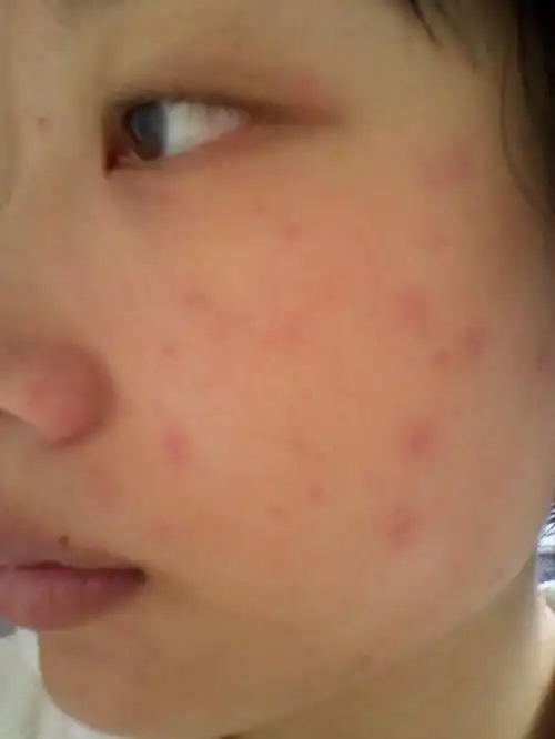 脸上过敏红肿怎么办