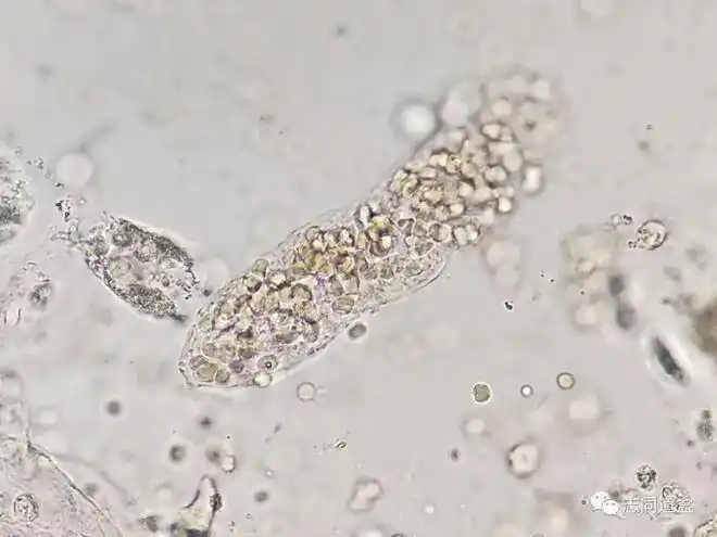 【多图对比】血液管型与血红蛋白管型鉴别|红细胞|镜检|沉渣_网易订阅