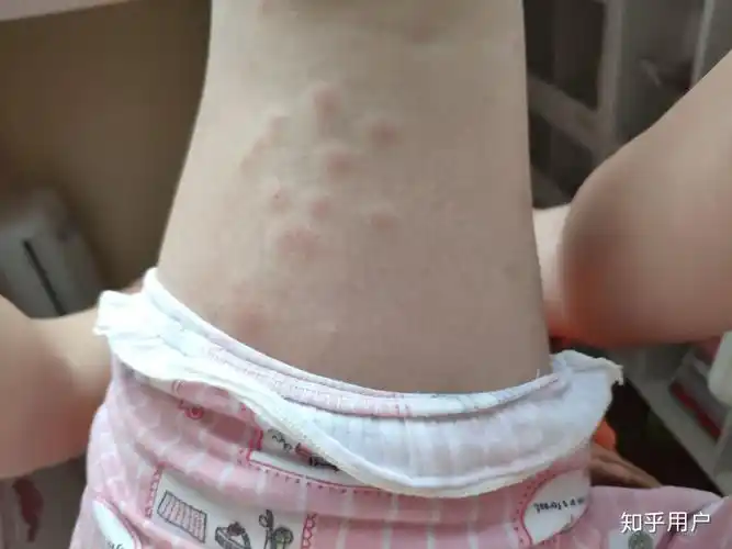 被跳蚤咬的全身都是包是什么样的感受