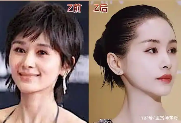 王子文,如何解决面部凹陷?