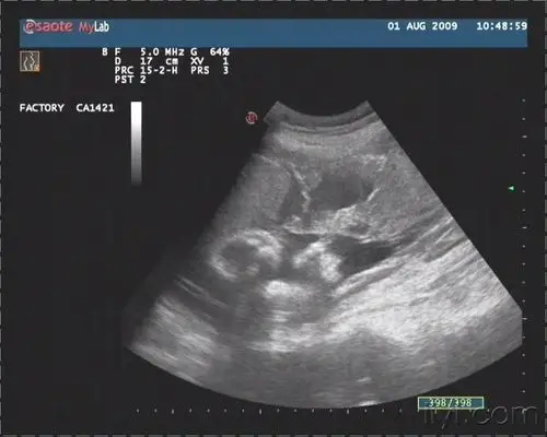 是不是胎盘血池