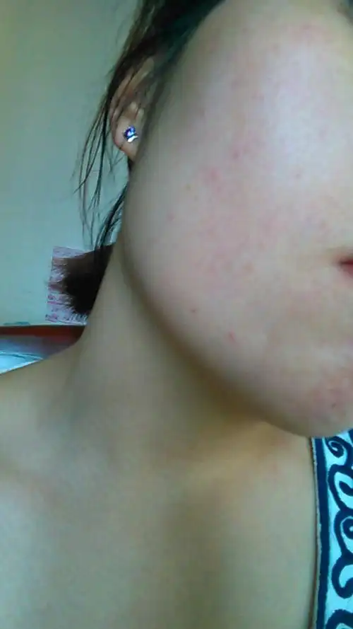 脸上冒了很多这种痘痘,不知道是不是过敏,帮我看一下.