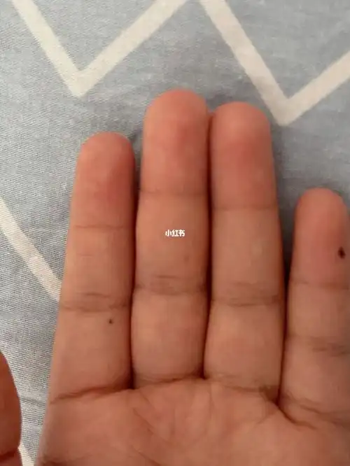 为什么拇指会长痣