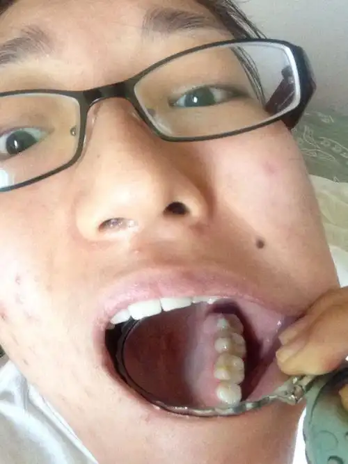 11岁的时候整过牙,下面没拔,上面拔了左右虎牙后面的两颗.