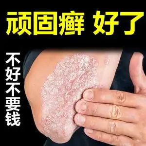治癣药膏