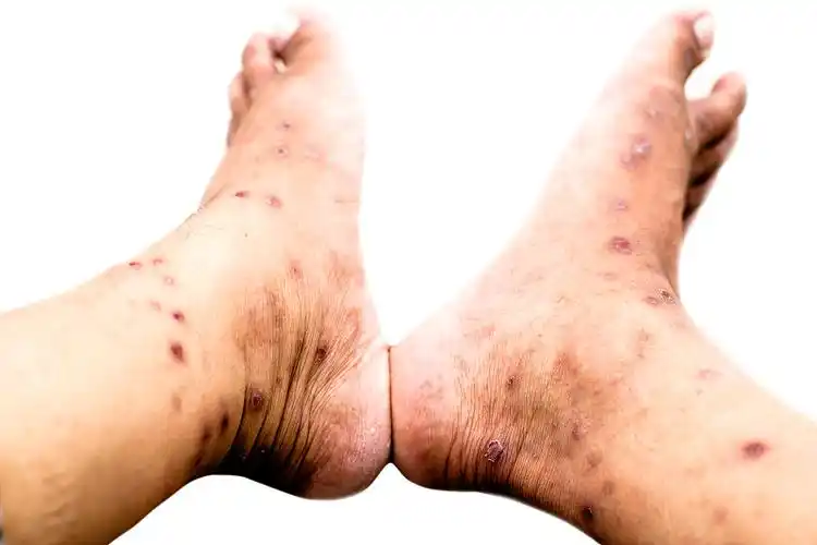 皮肤过敏伴皮疹皮炎问题,过敏皮疹和健康问题图片下载