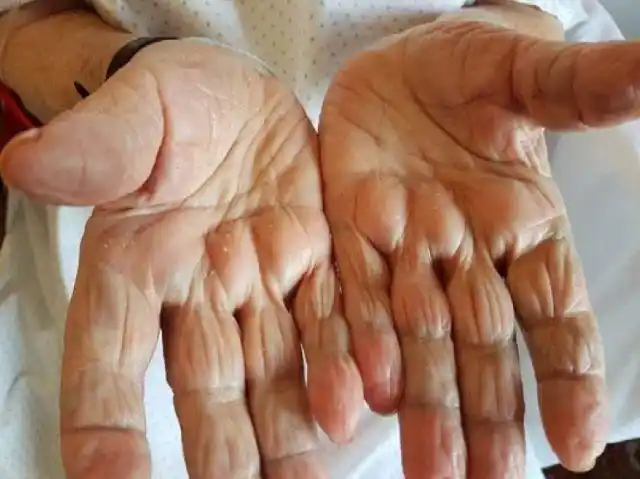 查体见双手掌数毫米大小的角化性丘疹(见图 1),组织学改变符合角化不