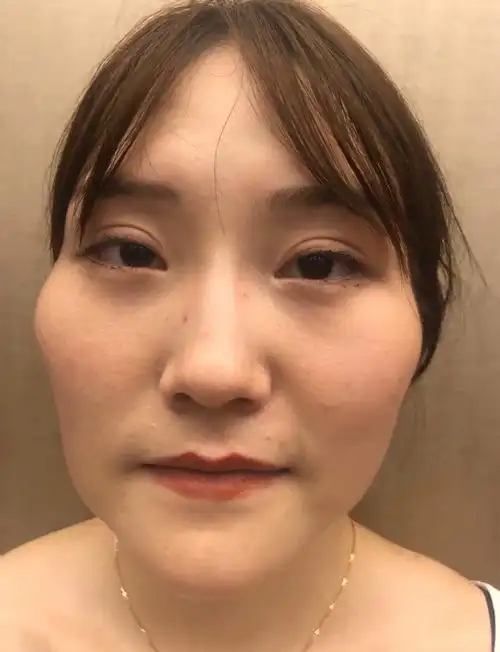 很多女性会觉得自己的颧骨凸出,线条不够美丽,给人一种尖酸刻薄,难以